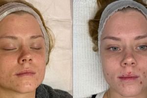 Trattamenti Anti-Acne