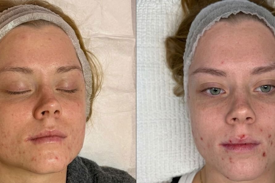 Trattamenti Anti-Acne